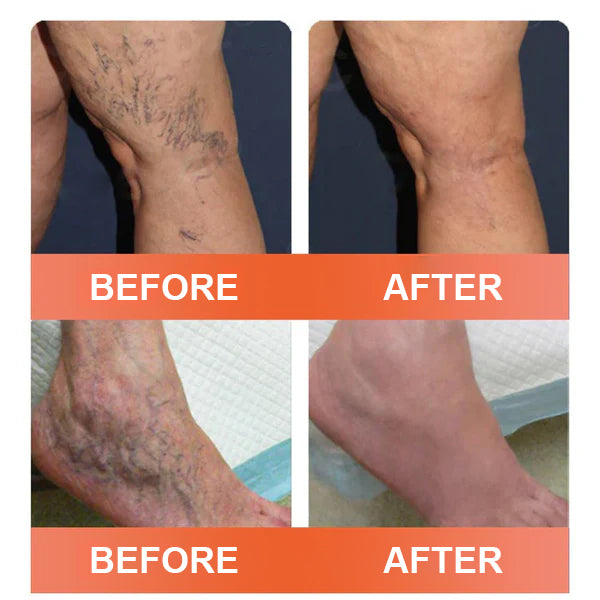 Seurico VeinEase Mikronadel-Therapie- Aufnaher